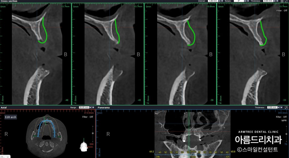 전체임플란트 전악임플란트 전후 아름드리치과 진료일기 관련 이미지 8