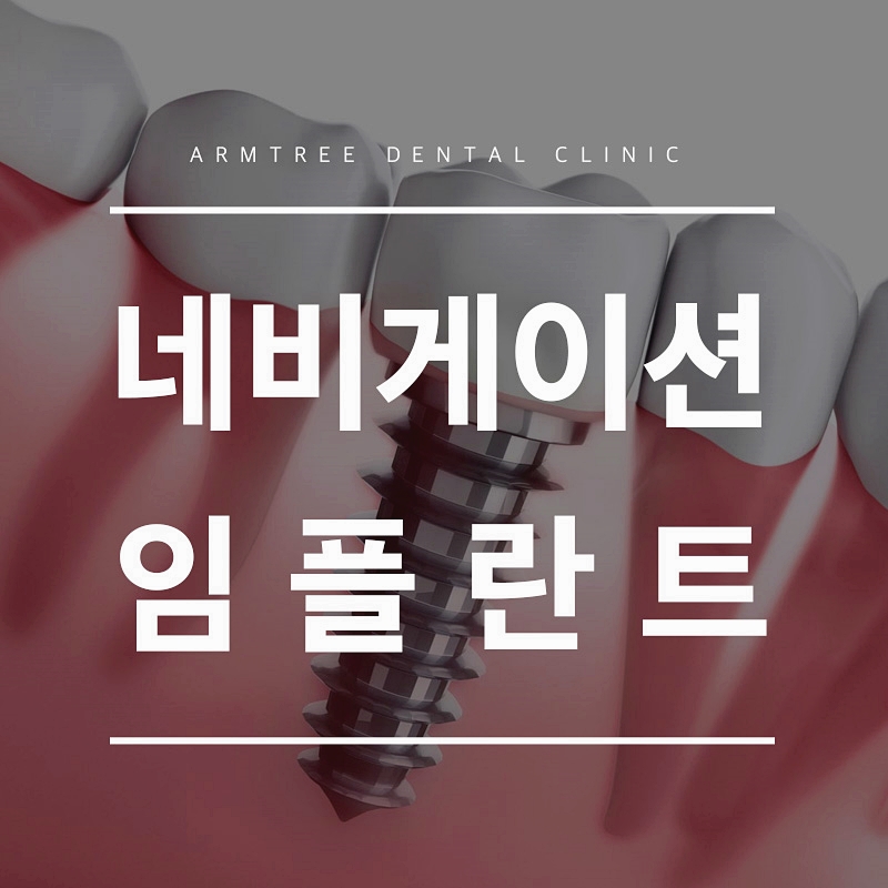 네비게이션임플란트 꼼꼼히 따져보면 관련 이미지 1