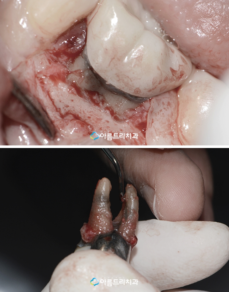 잇몸고름주머니치료 염증제거 아름드리치과 관련 이미지 5
