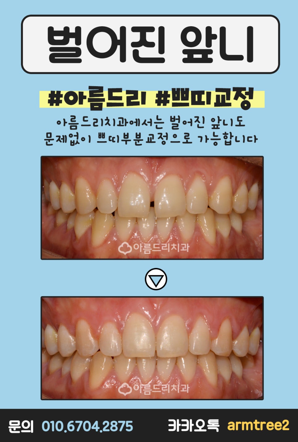 벌어진앞니부분교정 쁘띠교정 OK! 관련 이미지 2