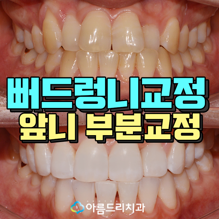 뻐드렁니 교정부분으로 빠르게 관련 이미지 1
