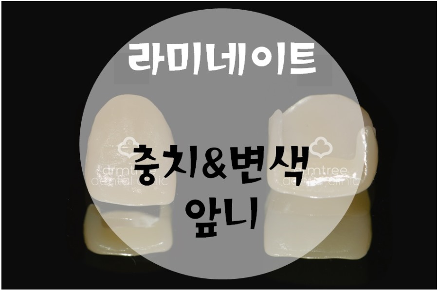 앞니 충치,앞니변색은 라미네이트로 해결(라미네이트가격문의) 관련 이미지 1