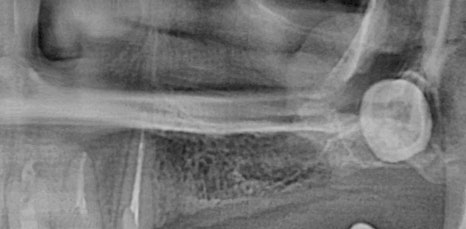 신논현역임플란트 아름드리치과에서 상악동거상술이 필요하면 관련 이미지 7