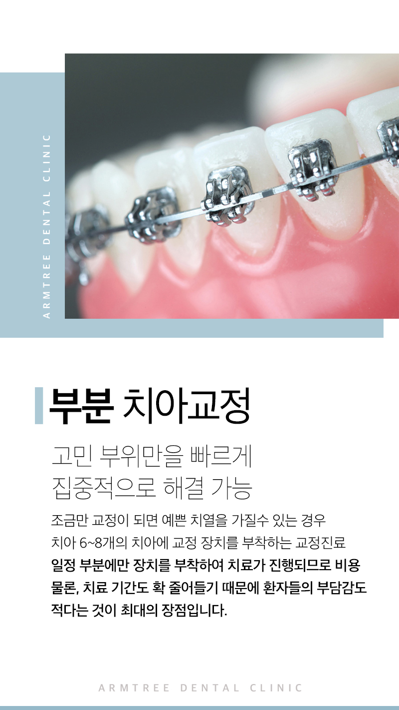 앞니부분교정 꼼꼼하고 예리하게 관련 이미지 5