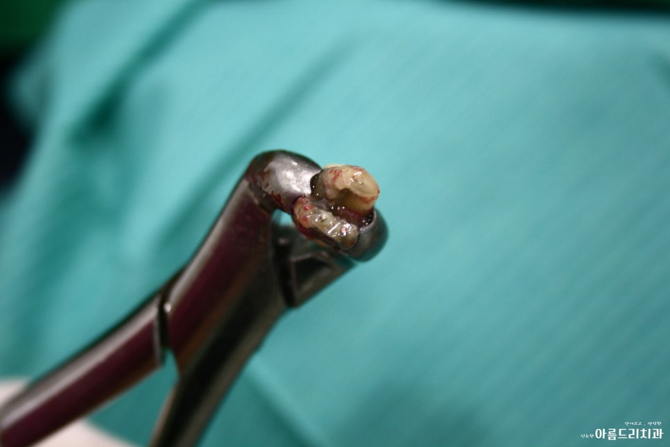 치아재식_임플란트 안 하고 치아 살릴 순 없나요?(신논현역 치과) 관련 이미지 13