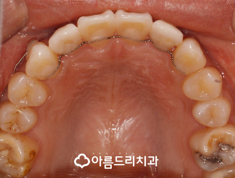 급속치아교정 코티코토미 피질골절단술 후기 관련 이미지 13
