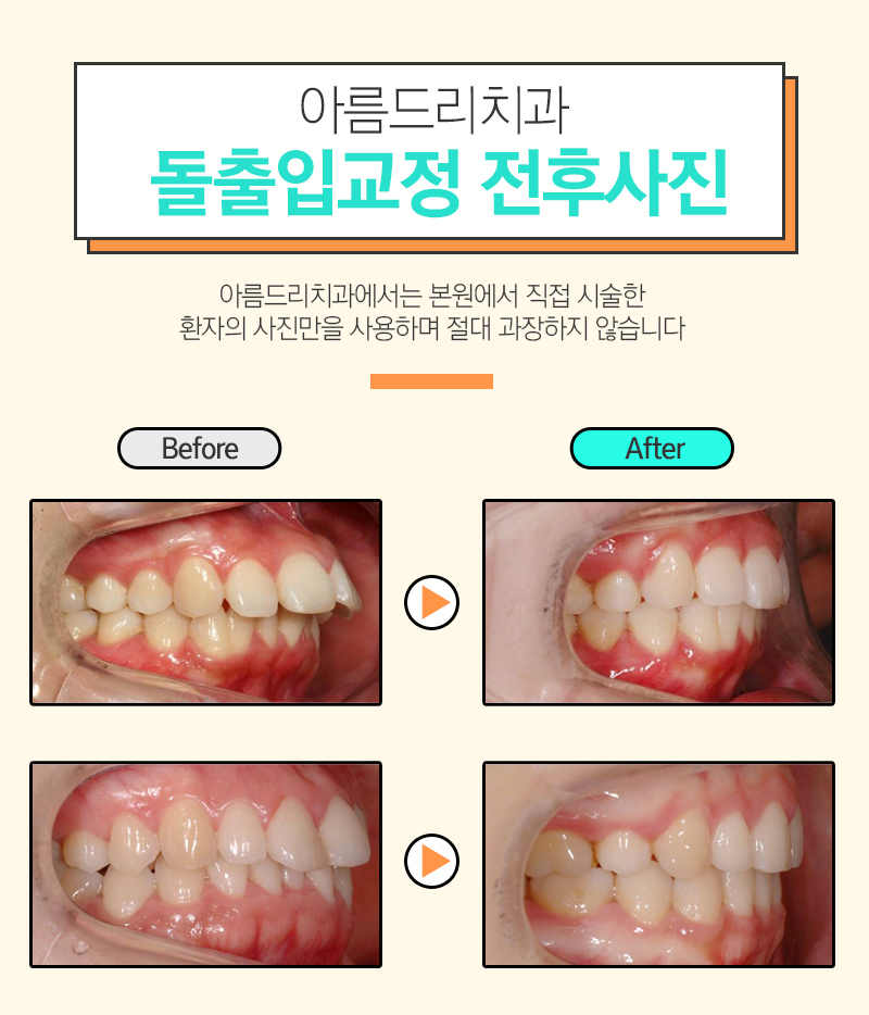 돌출입교정전후 새롭게 태어남 관련 이미지 7