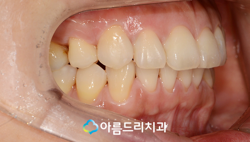 드라큘라이빨 송곳니교정 부분교정후기 관련 이미지 9