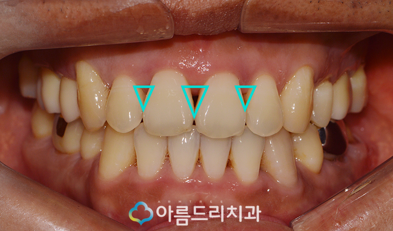 앞니 블랙트라이앵글 치아 이성형으로 해결 관련 이미지 4