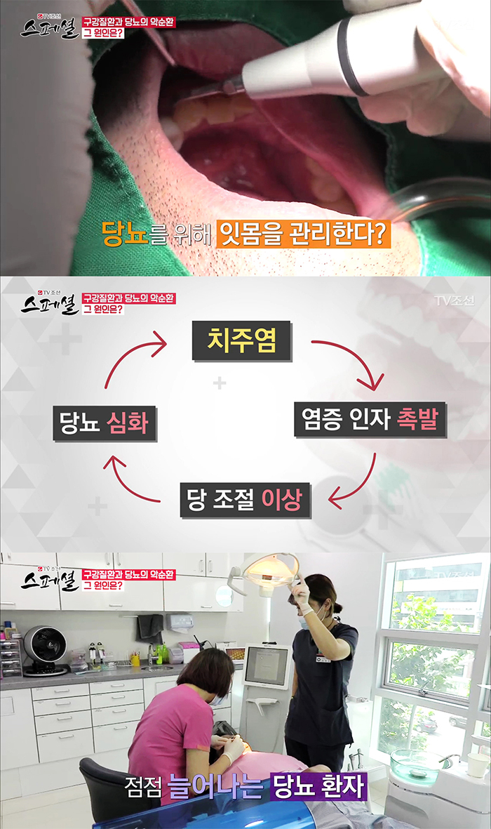 TV조선 스페셜 50회 구강건강관리 관련 이미지 5