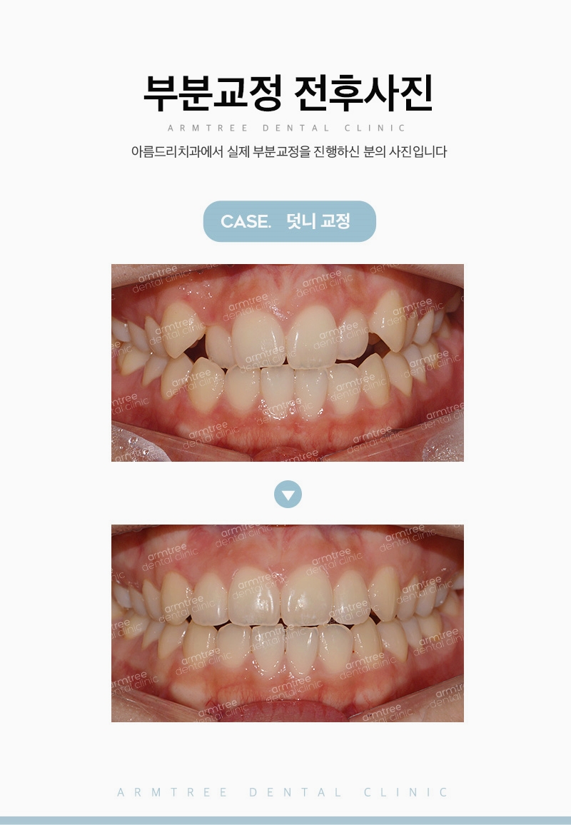 덧니부분교정으로 자연스러운미소 아름드리치과 관련 이미지 11