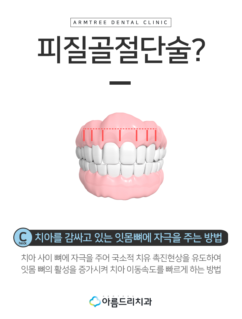 급속치아교정 코티코토미 피질골절단술 후기 관련 이미지 7