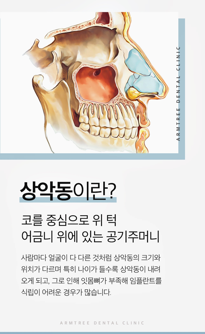 신논현치과 상악동거상술이 필요하다면 관련 이미지 3
