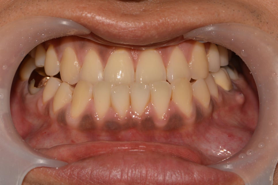 검은 잇몸! 잇몸미백으로 선홍빛 깨끗하게 관련 이미지 1