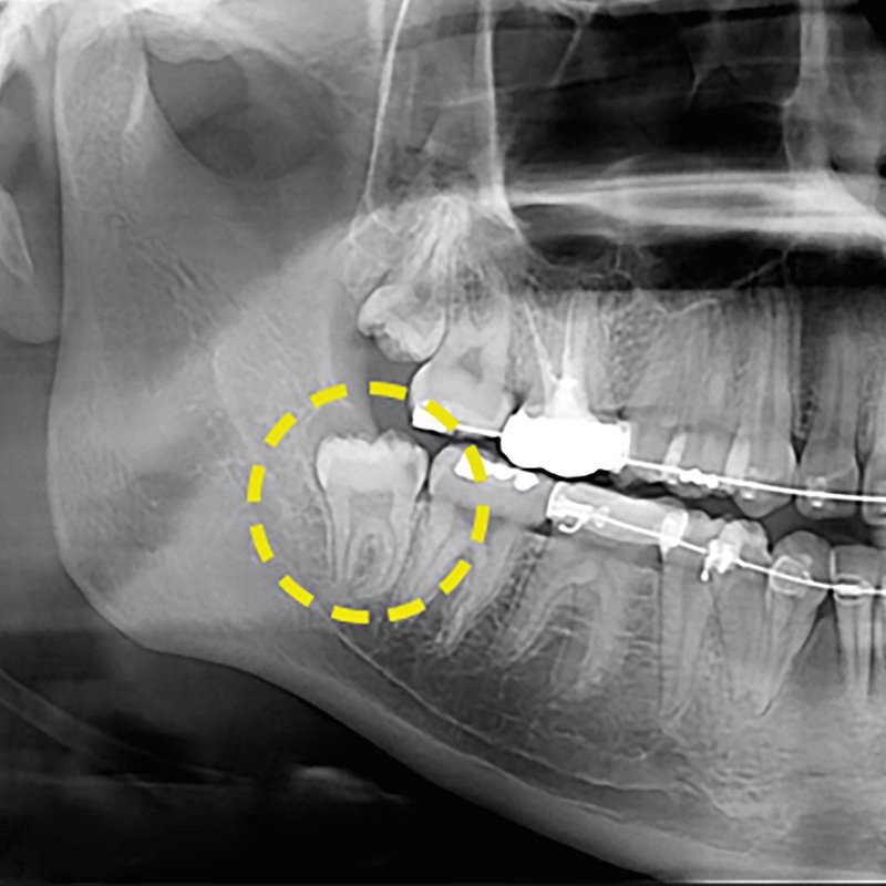 매복사랑니발치 통증없는 아름드리치과 관련 이미지 1