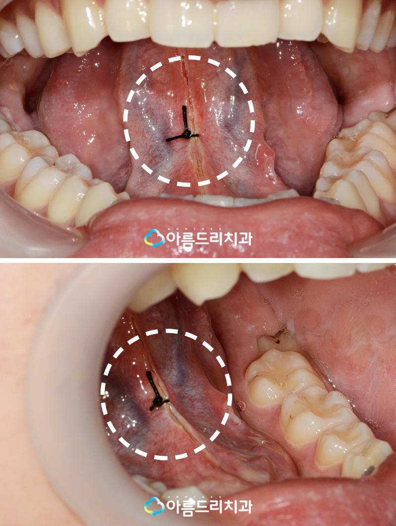 설소대단축증 - 단설소대증의 치료과정 관련 이미지 8