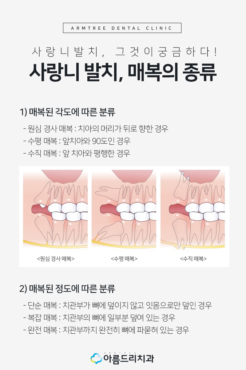 매복사랑니 발치후기 리얼하게 관련 이미지 4