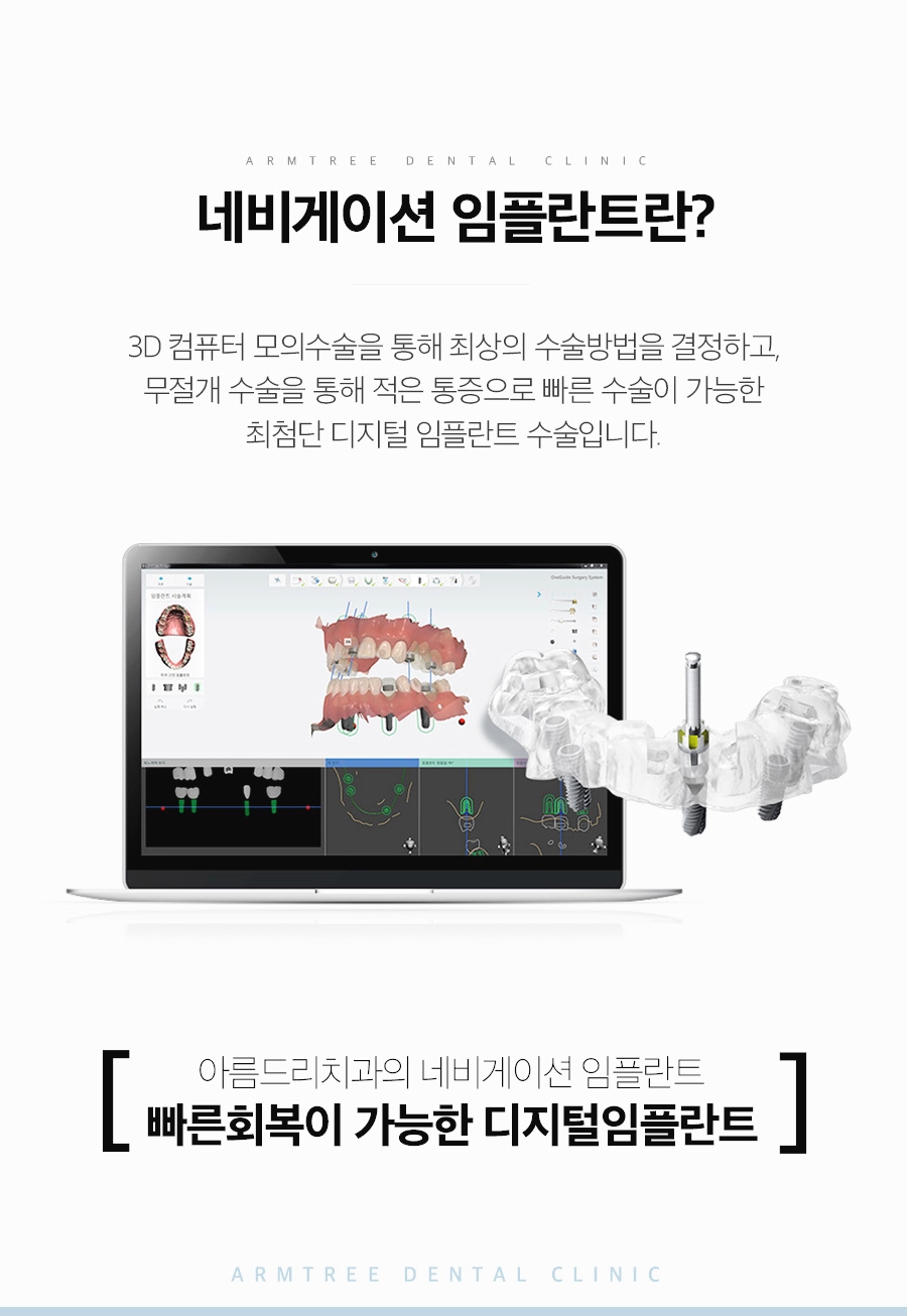 컴퓨터분석임플란트 아름드리치과의 네비게이션이 정답! 관련 이미지 3
