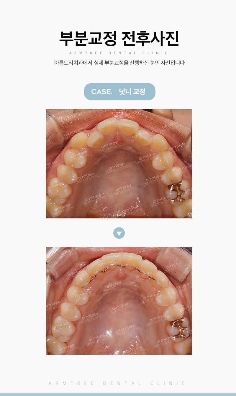 덧니부분교정으로 자연스러운미소 아름드리치과 관련 이미지 12