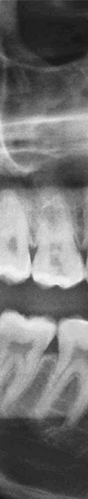 신논현역치과 사랑니 발치를 원한다면 관련 이미지 7