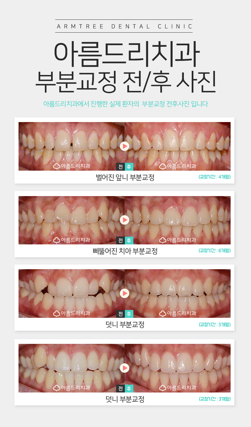 아랫니부분교정 가격 후기 정보후기 관련 이미지 8