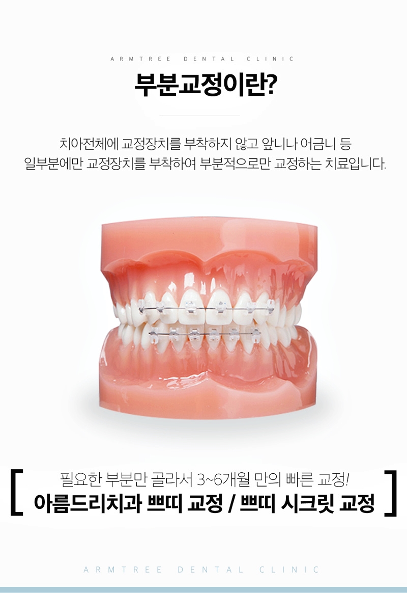 부분교정기간 신중하게 아름드리치과 관련 이미지 4