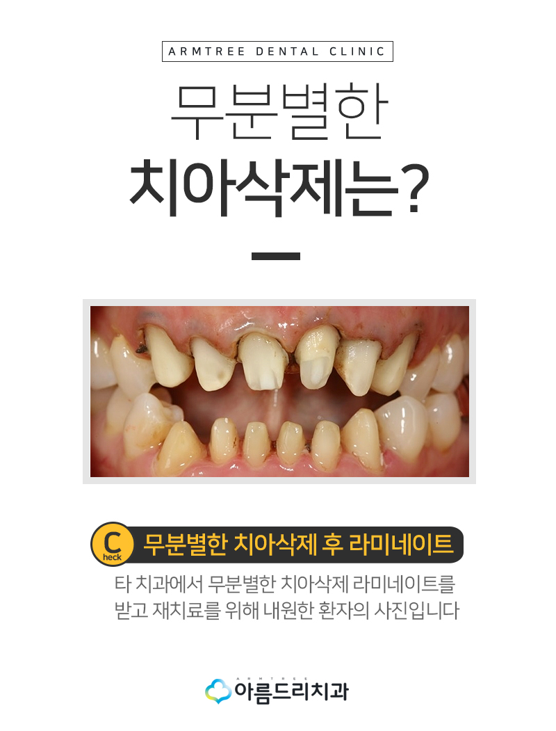 라미네이트교정 최소삭제 치아성형 후기 관련 이미지 4