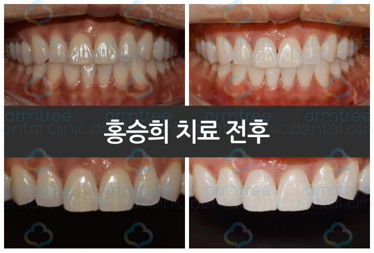 이현정 원장의 아름다운 당신 시즌 1 (9회 홍승희 도전자) 잇몸미백, 치아미백 관련 이미지 6