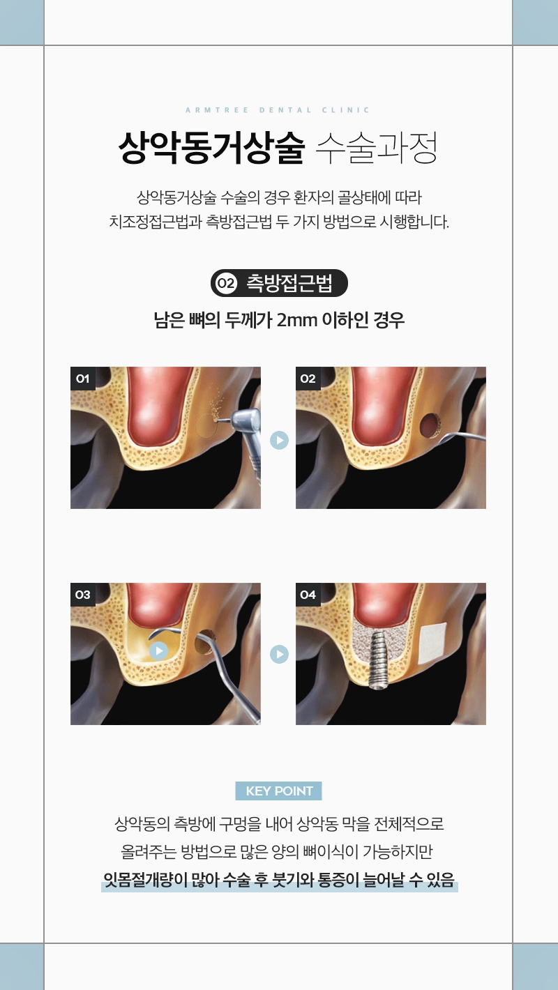 신논현치과 상악동거상술이 필요하다면 관련 이미지 5
