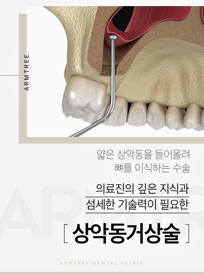 신논현역치과 상악동거상술과 임플란트는 아름드리치과에서 관련 이미지 2
