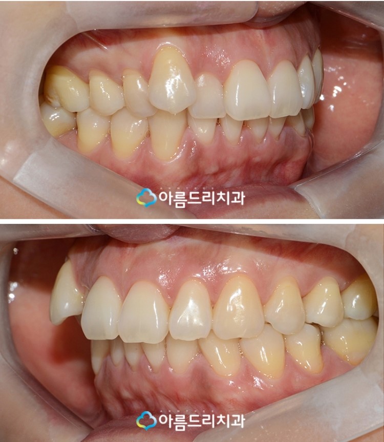 설측교정 후기앞니 단기간에 관련 이미지 4