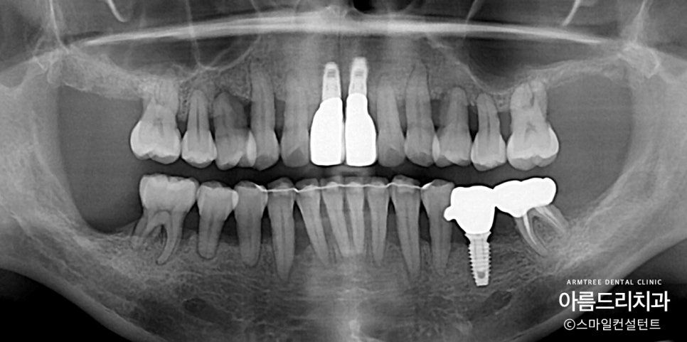 왜 임플란트와 치아교정을 다 잘아는 곳에서 치료해야할까?| 아름드리치과 진료일기 관련 이미지 2