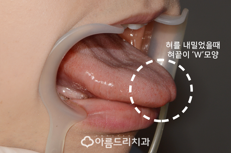 성인 설소대수술 비용 리얼후기 관련 이미지 5