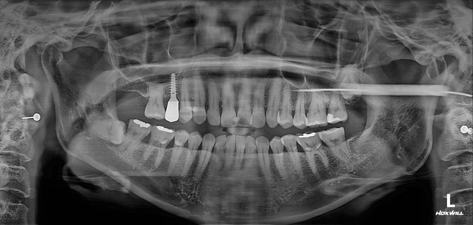 무절개 무봉합 상악동 거상술 관련 이미지 4