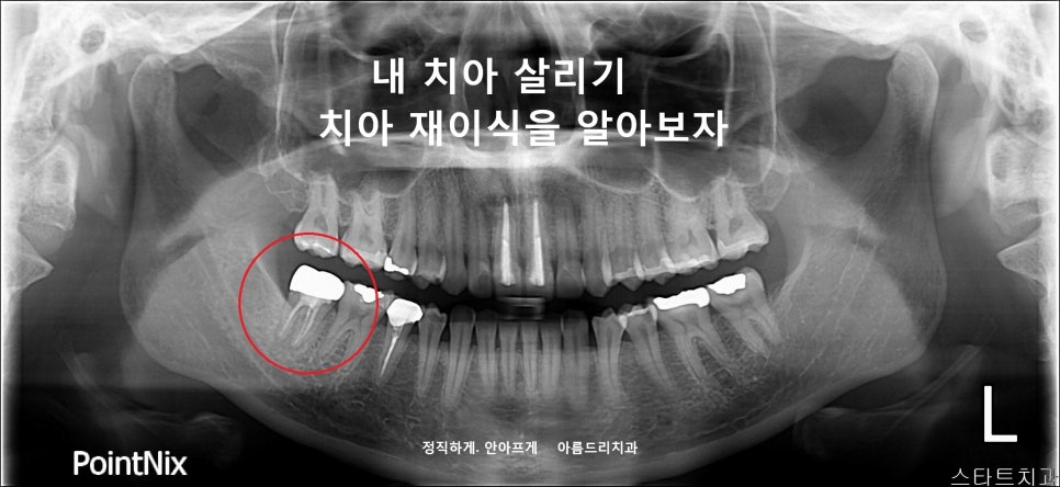 [신논현 치과] 임플란트 대신 치아재식(아름드리치과) 관련 이미지 2