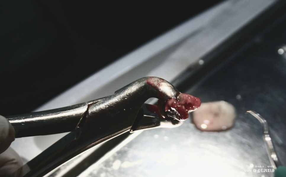 치아재식_임플란트 안 하고 치아 살릴 순 없나요?(신논현역 치과) 관련 이미지 7