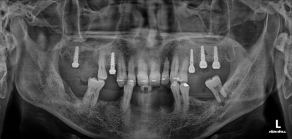 부분교정+임플란트(진료일기) 관련 이미지 4