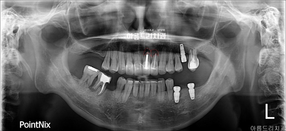뽑지 않고 자가치아를 살려주세요_치아 뿌리수술_치근단절제술+뼈이식 관련 이미지 5