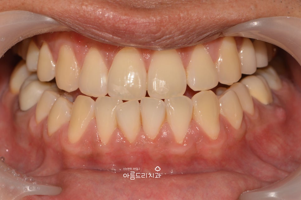 검은 잇몸! 잇몸미백으로 선홍빛 깨끗하게 관련 이미지 12