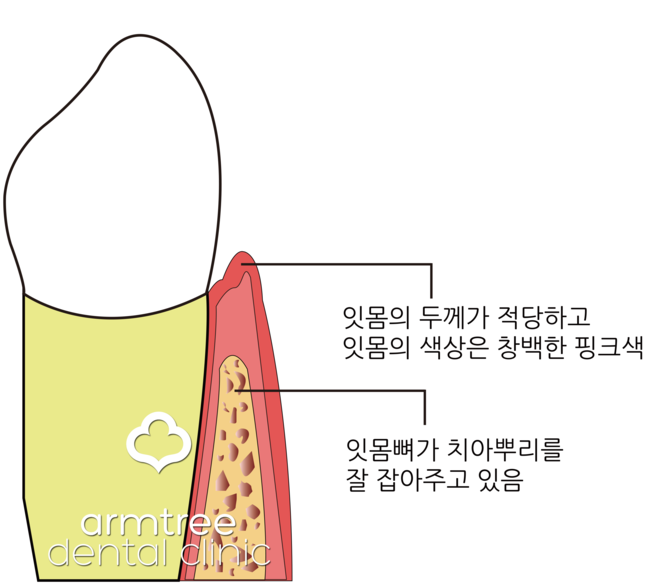 아름드리치과 이현정원장 - 스케일링 왜 중요한가? 관련 이미지 4