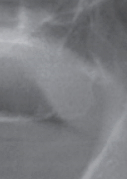 반포치과 전악임플란트는 풀아치 임플란트로 관련 이미지 9