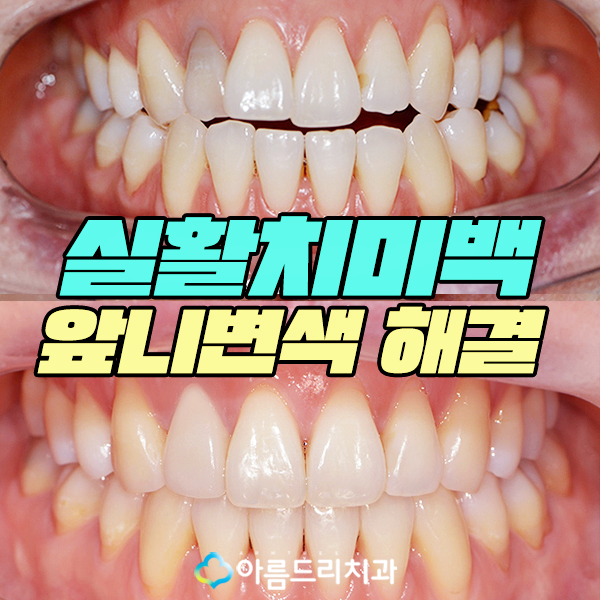 실활치미백 - 앞니변색을 해결하는 치료 관련 이미지 1