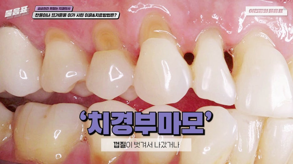 찬물 뜨거운물 이시림 원인! 이가 시린이유 아름드리치과 관련 이미지 6