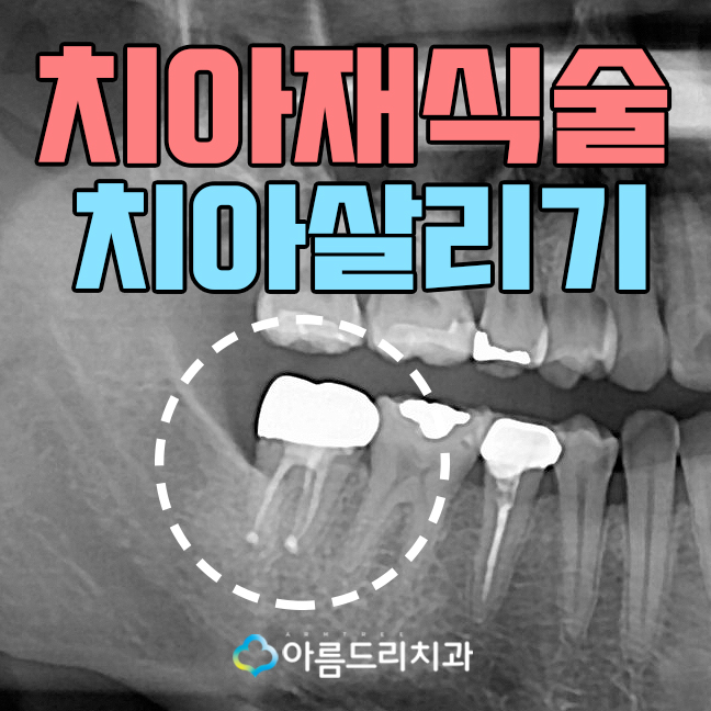 치아재식술 자연치아 살리기 후기 관련 이미지 1