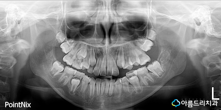 어린이치아교정 부정교합 성장판 검사 관련 이미지 10