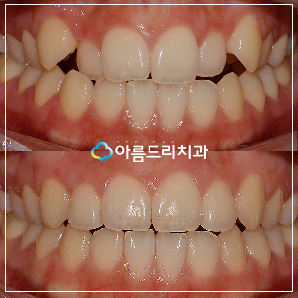 앞니부분교정기간 후기의 변화 관련 이미지 1