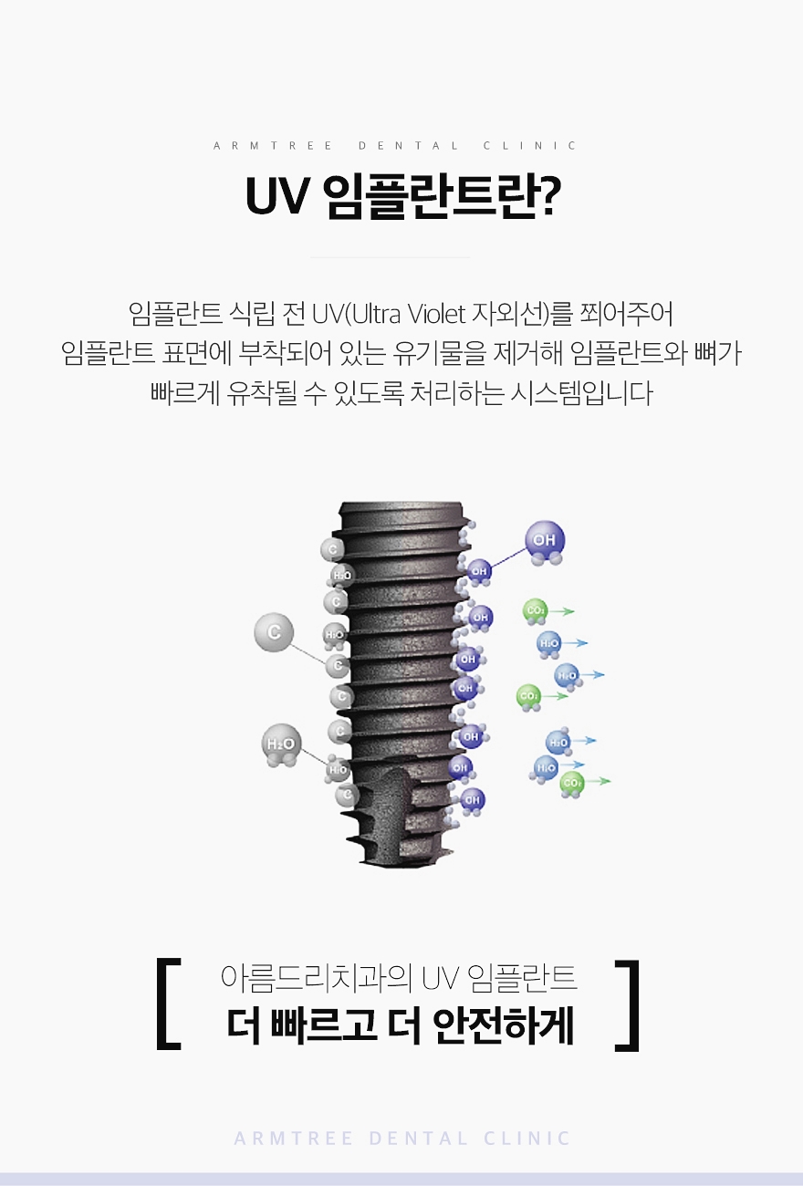 UV임플란트 꼼꼼히 따져보면 관련 이미지 3