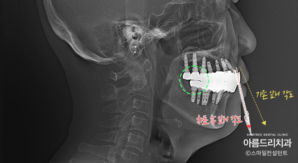 임플란트 심미보철 전후 아름드리치과 진료일기 관련 이미지 7