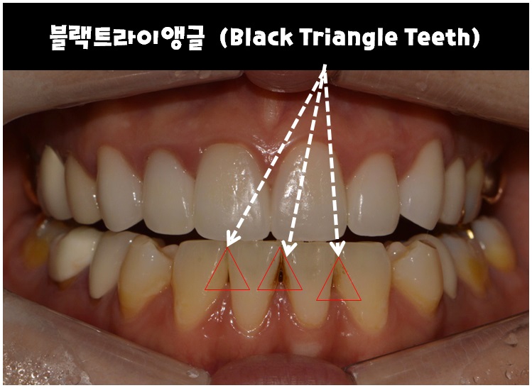 앞니 변색 _ 블랙 트라이앵글 #올 세라믹 관련 이미지 3