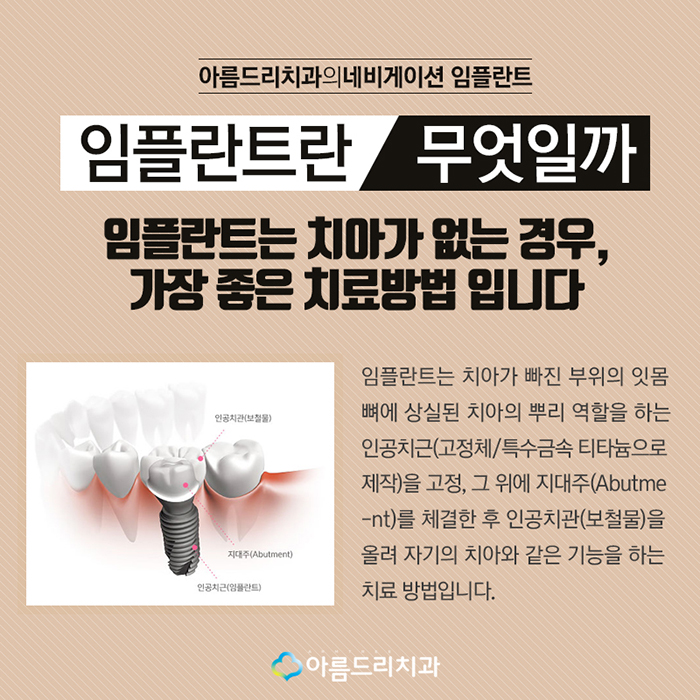 치아인플란트 네비게이션인플란트의 안전함 관련 이미지 2